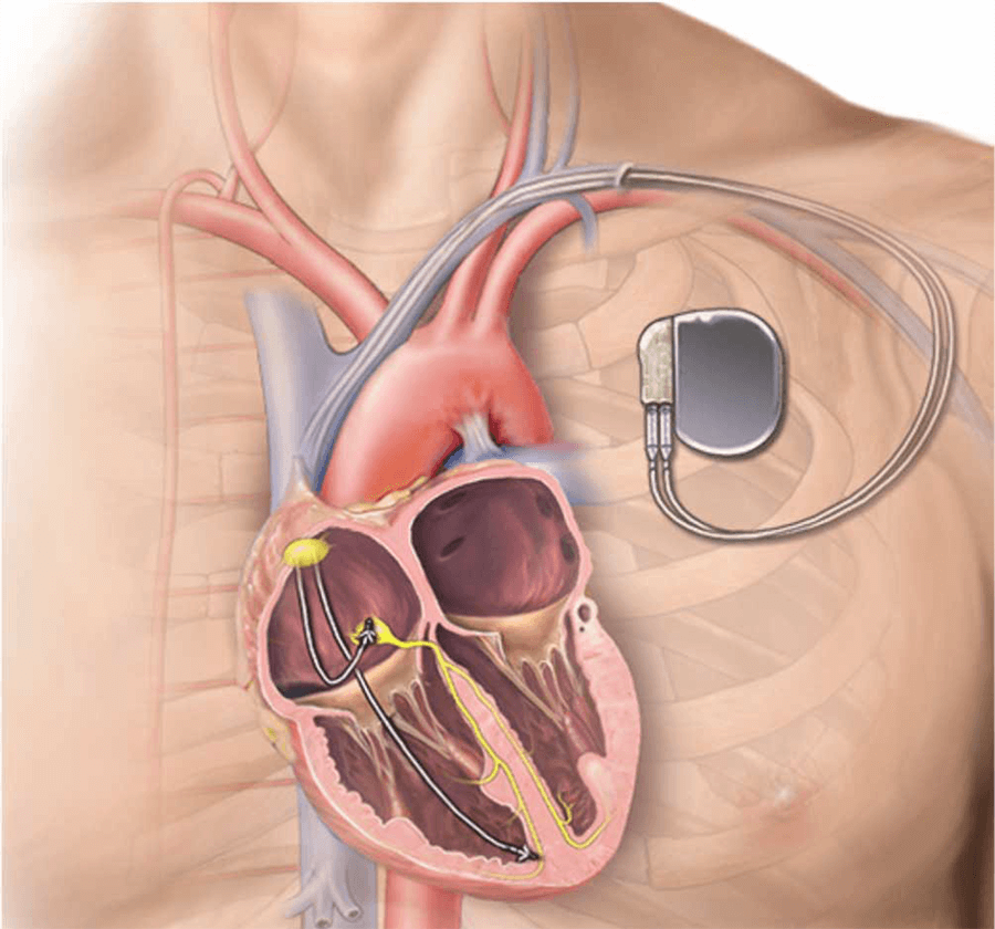Pacemaker Implantation