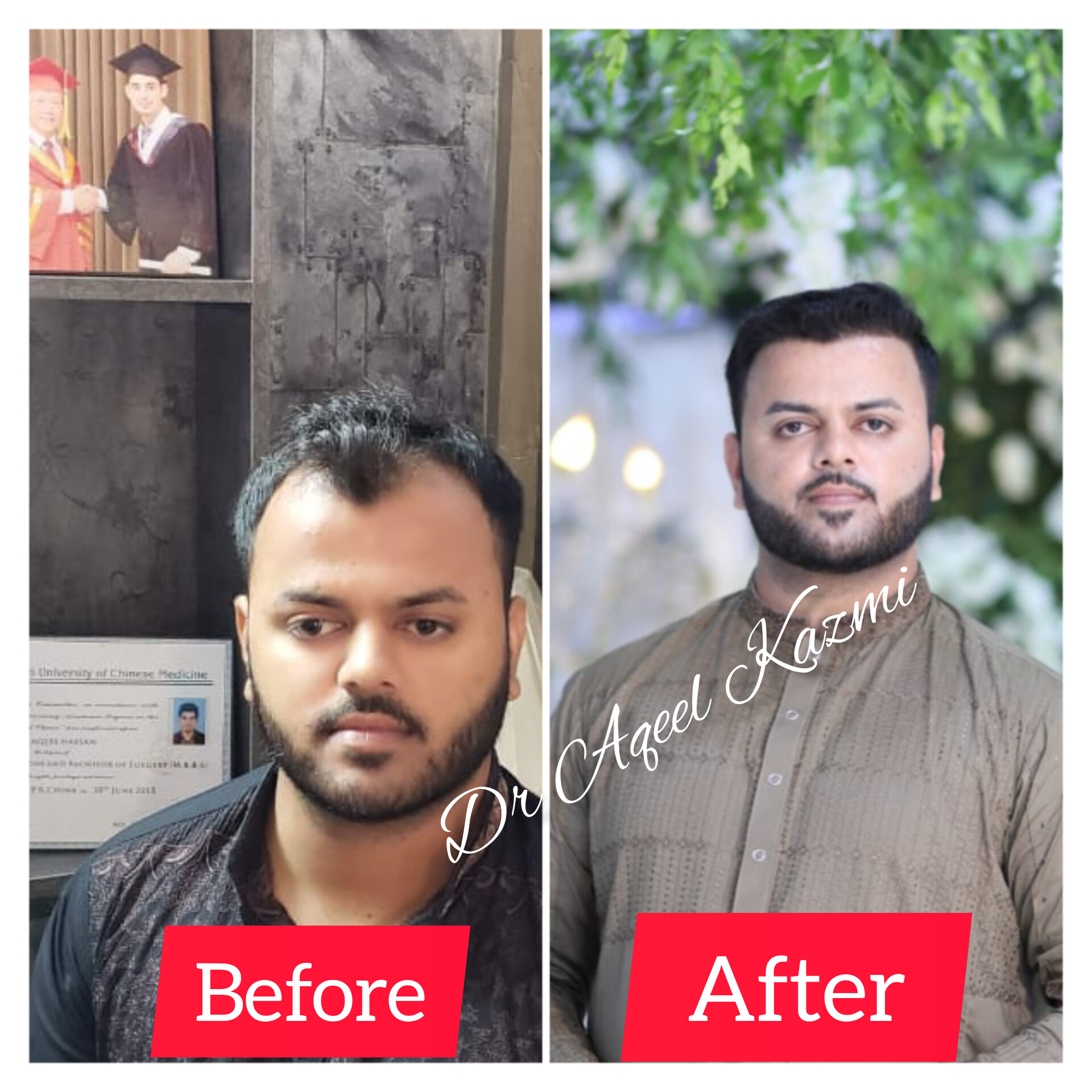 Hair Transplant