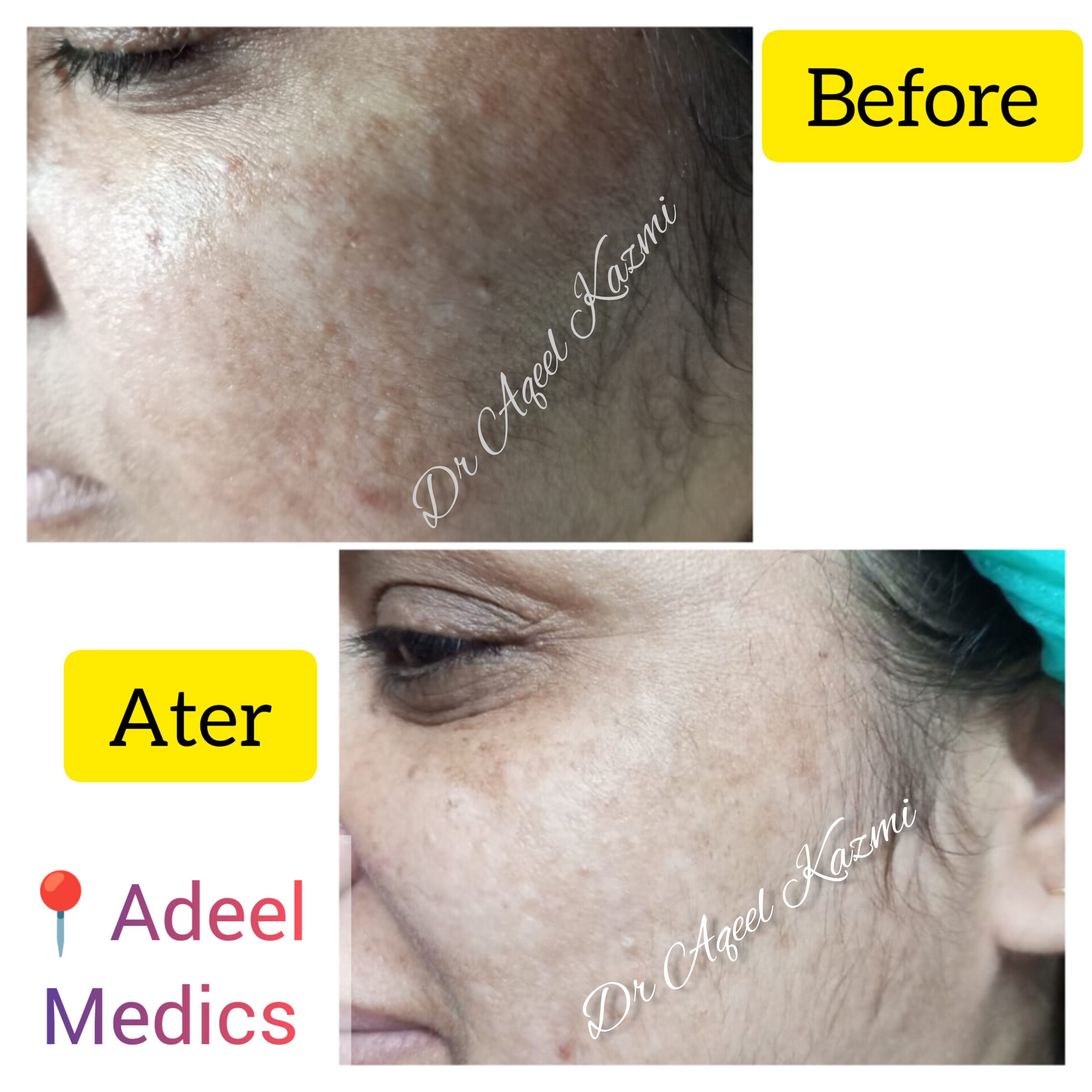 Melasma treatment