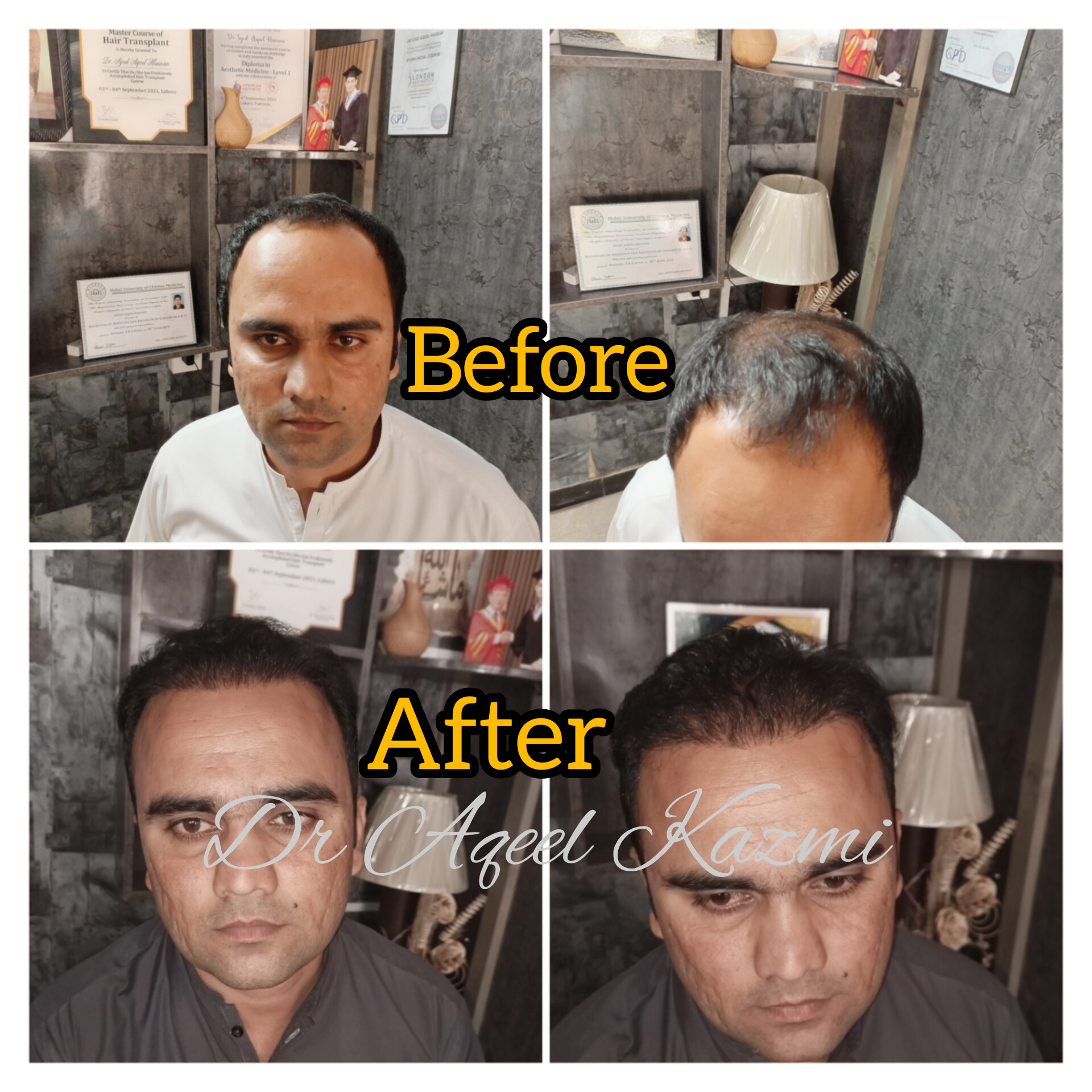 Hair Transplant