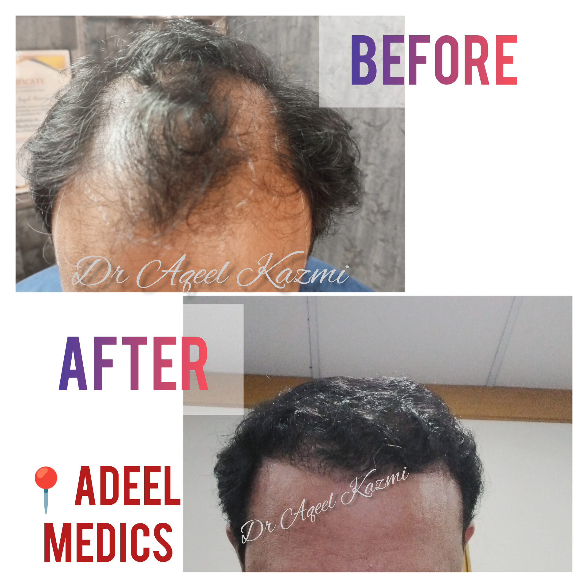 Hair transplant