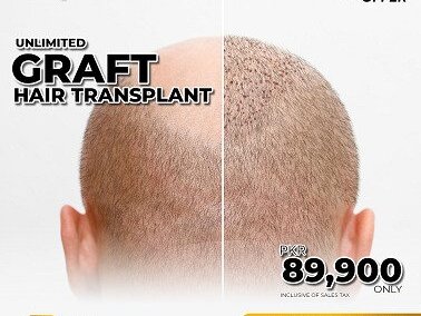 Hair Transplant (Graft) by  American Aesthetics image 1