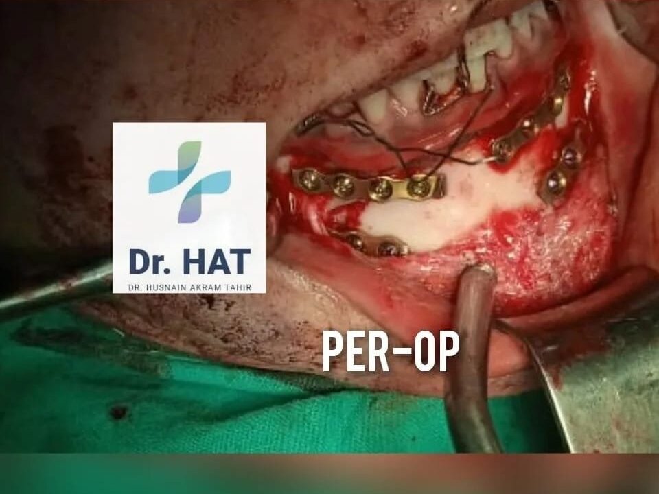 Dental Implants by Dr. Husnain Akram Tahir image 1