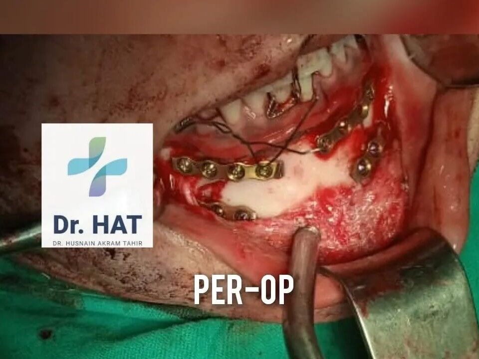 PRP for Hair Fall by Dr. Husnain Akram Tahir image 1