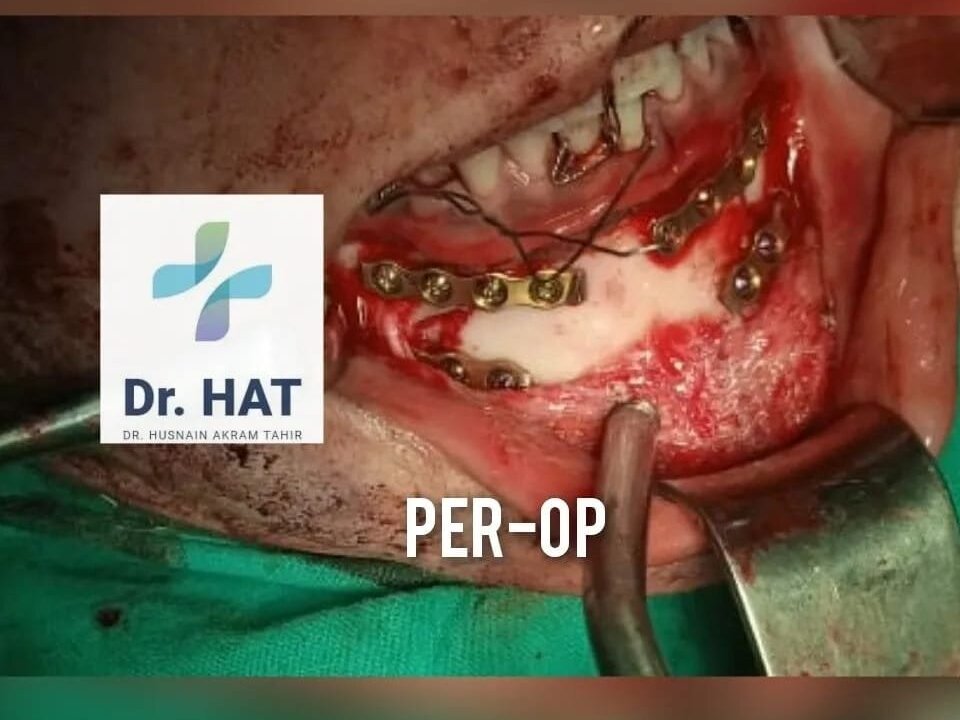 Incision & Drainage for Facial Abcsess by Dr. Husnain Akram Tahir image 1