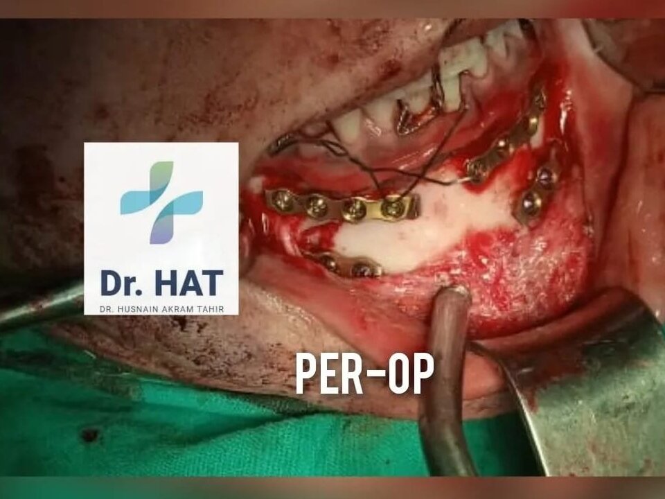 Wisdom Teeth Extractions by Dr. Husnain Akram Tahir image 1