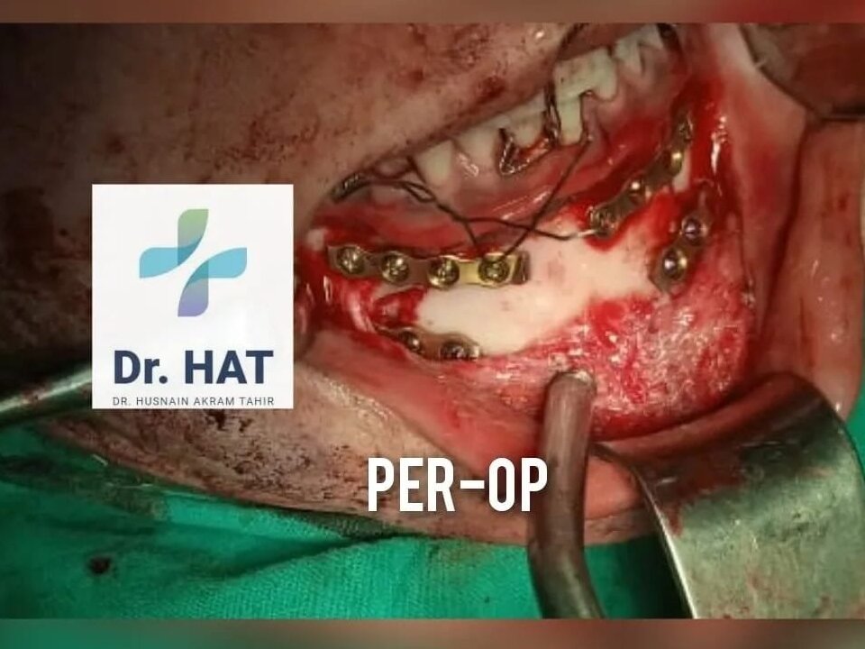 TMJ Joint Jaw Arthrocentesis by Dr. Husnain Akram Tahir image 1