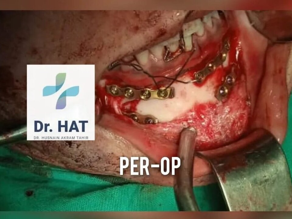 Full face Fractures by Dr. Husnain Akram Tahir image 1