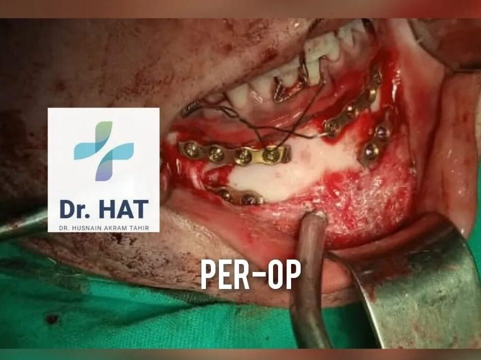 Closed Reduction of Facial Fractures by Dr. Husnain Akram Tahir image 1