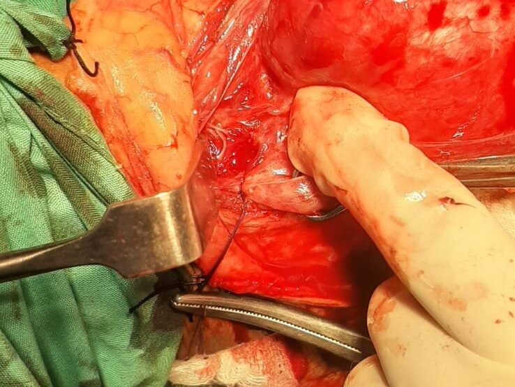 Appendectomy (Laparoscopic) by Dr. Umair Tahir Chaudary image 1
