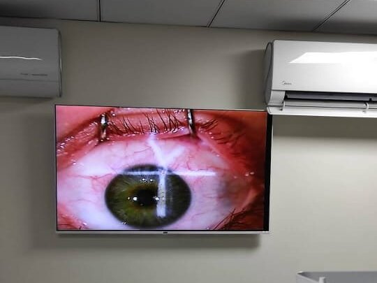 PRK Laser for Glasses Removal by Assist. Prof. Dr. Adeel Randhawa image 1