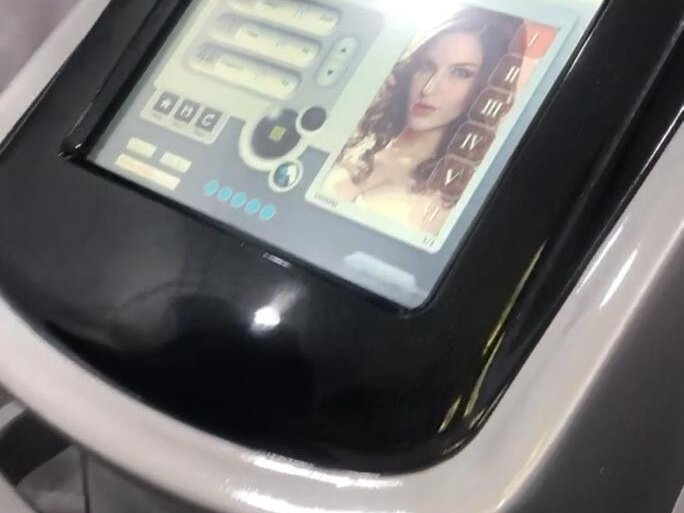 Microneedling with PRGF for Acne Scars by Assist. Prof. Dr. Arif Baig Mirza image 1