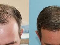 Test hair transplant by Mr. Arif Zuberi image 1